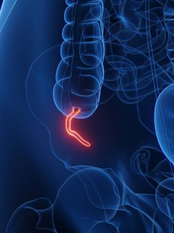 Ostre zapalenie wyrostka robaczkowego – objawy, przyczyny oraz diagnostyka