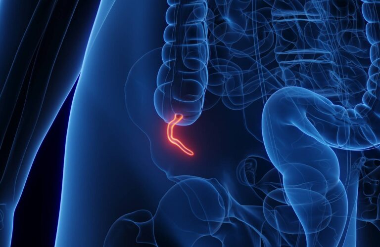 Ostre zapalenie wyrostka robaczkowego – objawy, przyczyny oraz diagnostyka