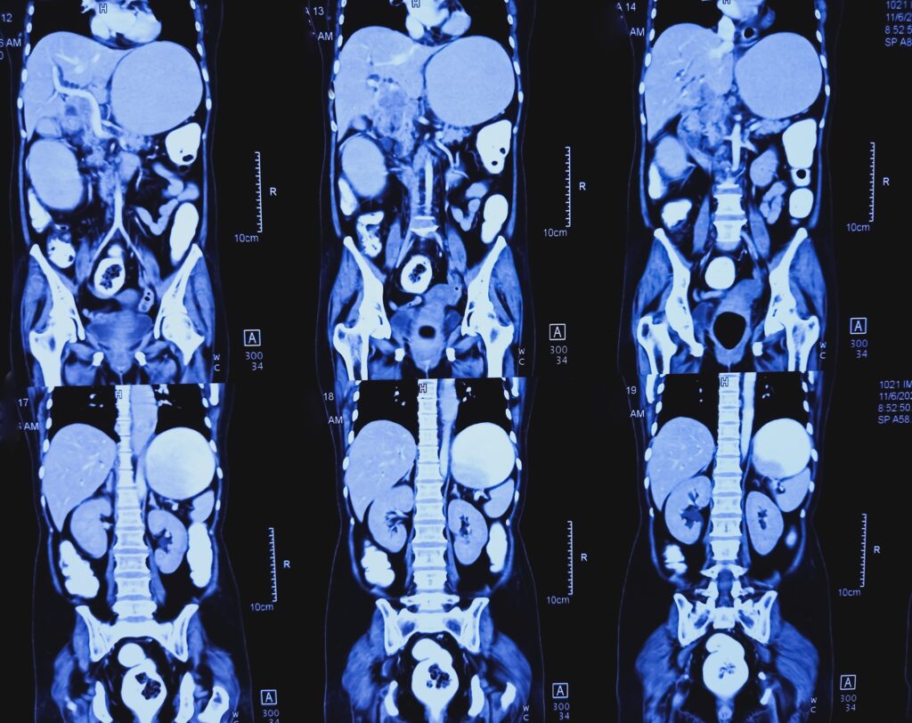 Tomografia komputerowa jamy brzusznej – obecność stanu zapalnego w obrębie jamy brzusznej i podejrzenie ropnia okołowyrostkowego przy ostrym zapaleniu wyrostka robaczkowego.